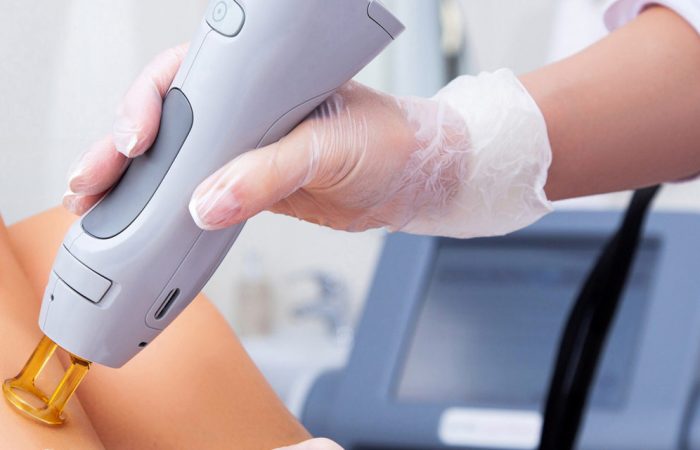 Laser Hair Removal